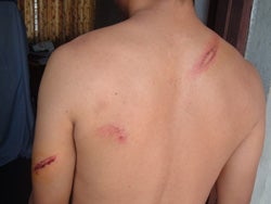 A transgender victim of April 12 police attacks in Nepal shows her wounds.