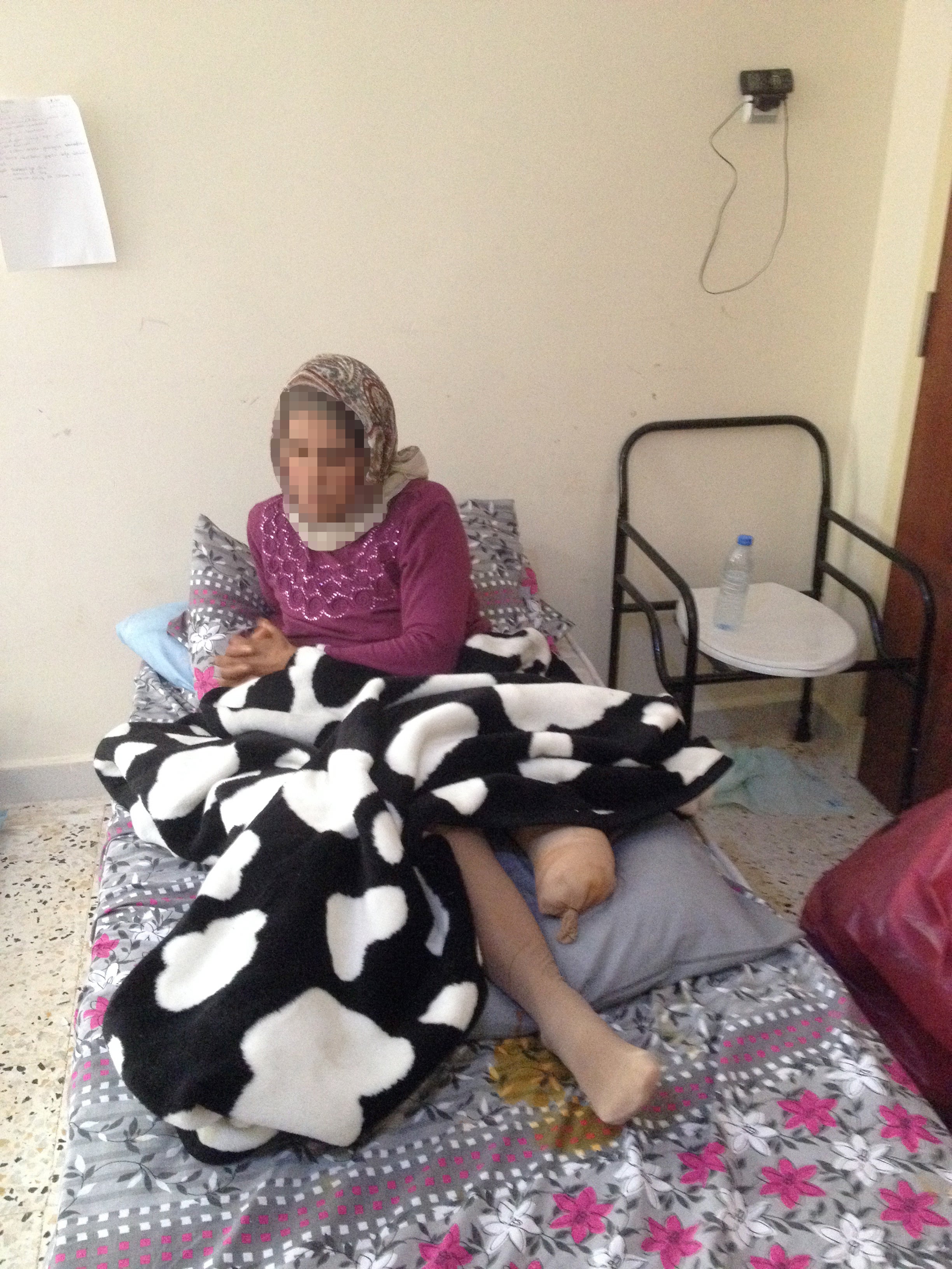 “Selma,” pictured here, and her daughter, were injured in a border minefield. “Selma”’s leg was amputated as a result of the injury.