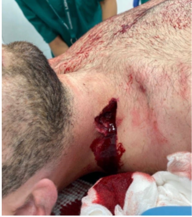 A kinetic impact projectile hit a protester in the neck.