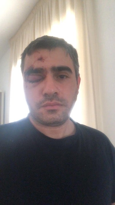 Rabie Barakat was struck in the head with a teargas cartridge, causing a fracture around his right eye, internal bleeding in the eye, and some bleeding in his brain.