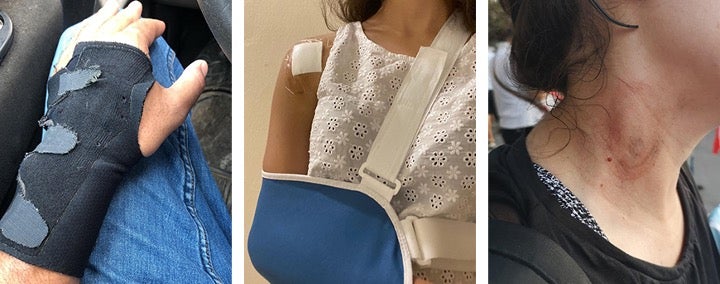 Three protesters injured by teargas cartridges fired directly at the torsos and heads. 