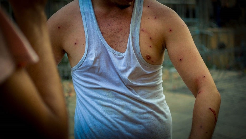 متظاهر أصيب بالكريات المعدنية.