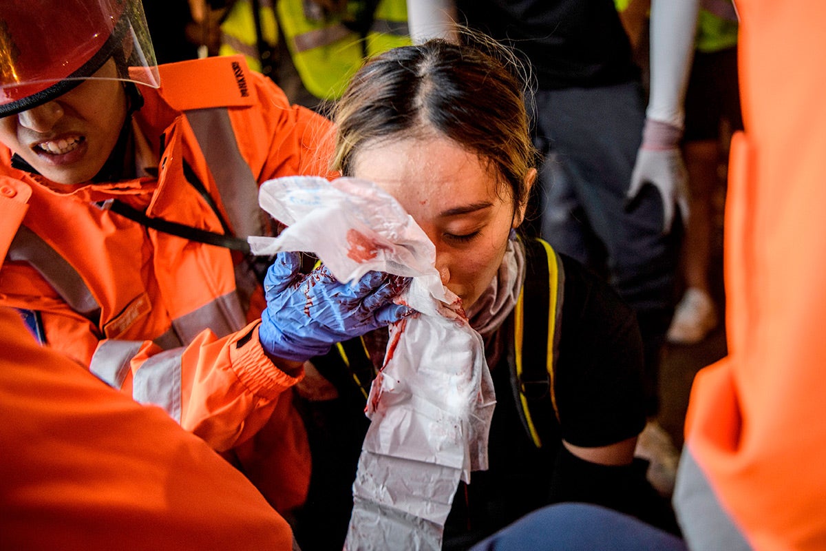 A&nbsp;woman&nbsp;who received an eye&nbsp;injury during a&nbsp;protest&nbsp;on August 11, 2019, reportedly due to police bean bag rounds. Her injury galvanized subsequent protests, with protesters&nbsp;wearing eye patches&nbsp;to&nbsp;protest against&nbsp;police violence.&nbsp;Pro-Beijing press has since cast doubt about her&nbsp;accounts, while police said they&nbsp;were investigating her&nbsp;for “riot[ing].