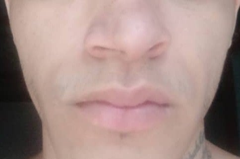 Photo of Daniel’s nose after the beatings at CECOT. 