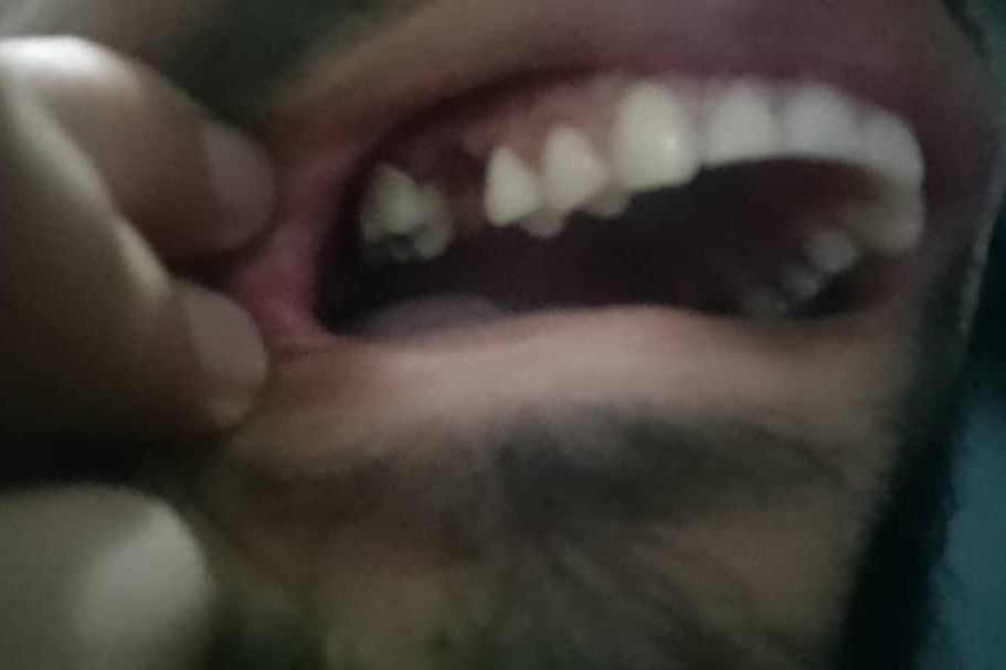 Photo of a gap left in Javier L.’s mouth after losing a tooth.