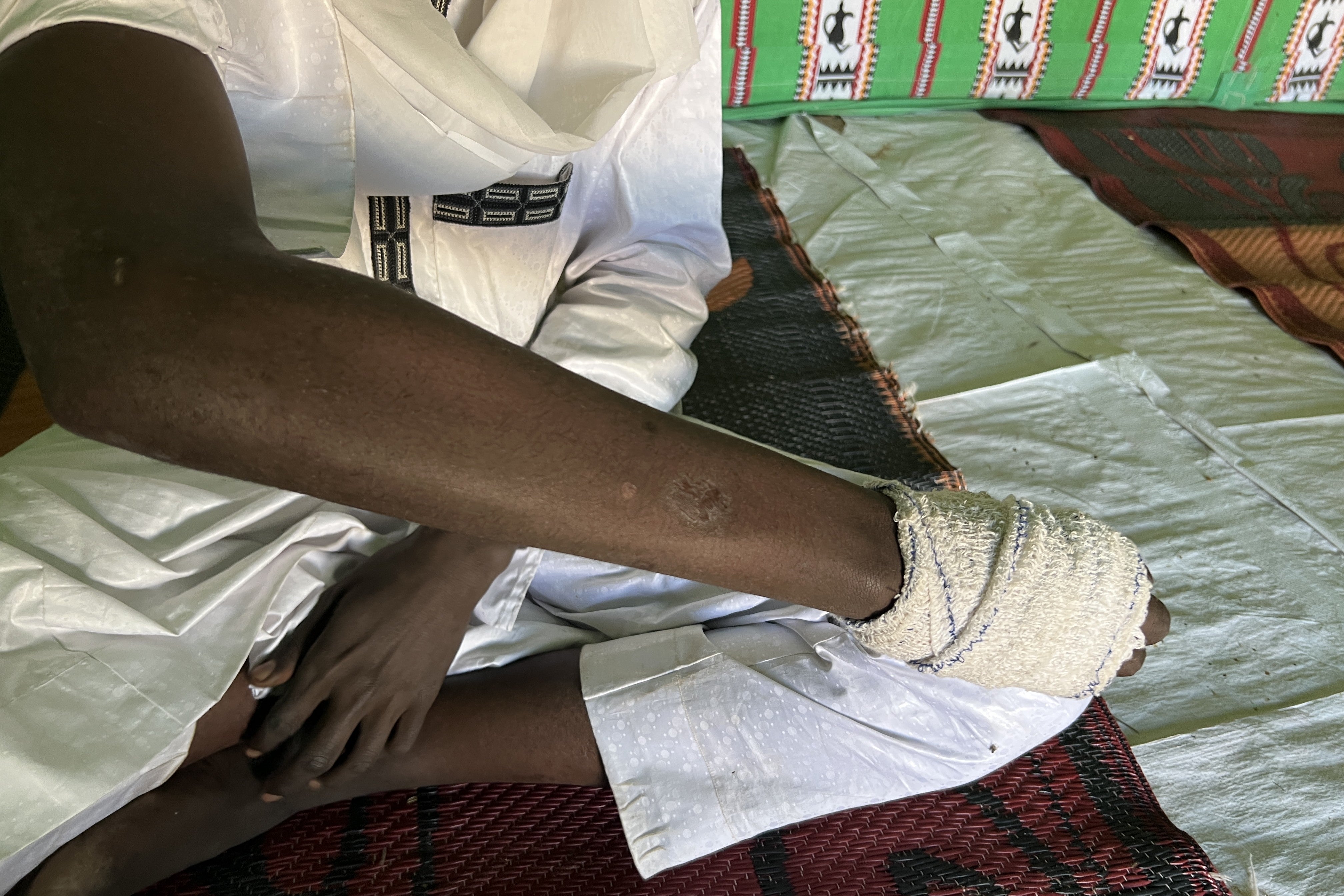 An arm/hand wrapped in bandages