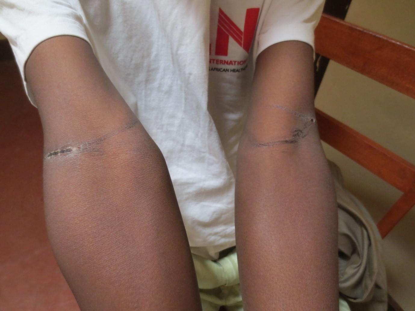 Imbonerakure (members of the ruling party youth league) attacked this 35-year-old former member of their party on July 2, 2015, tied his arms behind his back, beat him with sticks and tried to strangle him. 