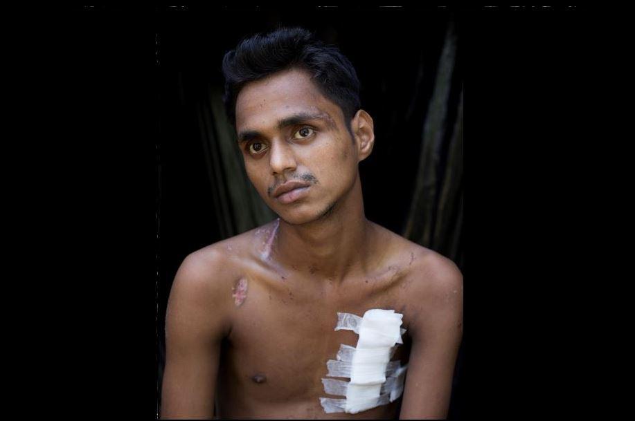 Muhamedul Hassan, un jeune homme rohingya âgé de 18 ans, originaire du village de Maung Nu en Birmanie, qui a été blessé par des coups de feu tirés par des soldats birmans.