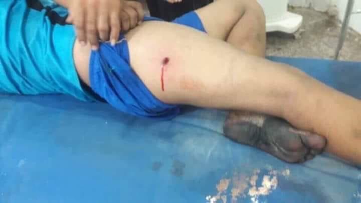 A protester displays a gunshot wound in his upper right thigh. He said Iraqi security forces shot him at a demonstration outside of al-Qurna oil field on July 10, 2018. © 2018 Private