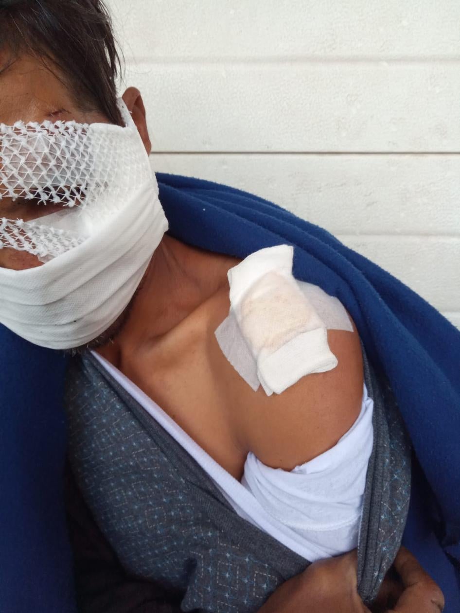 A migrant sustained severe head injury and a broken arm following a brutal beating by, what he stated was, six Croatian police officers during a pushback on October 16, 2020. 