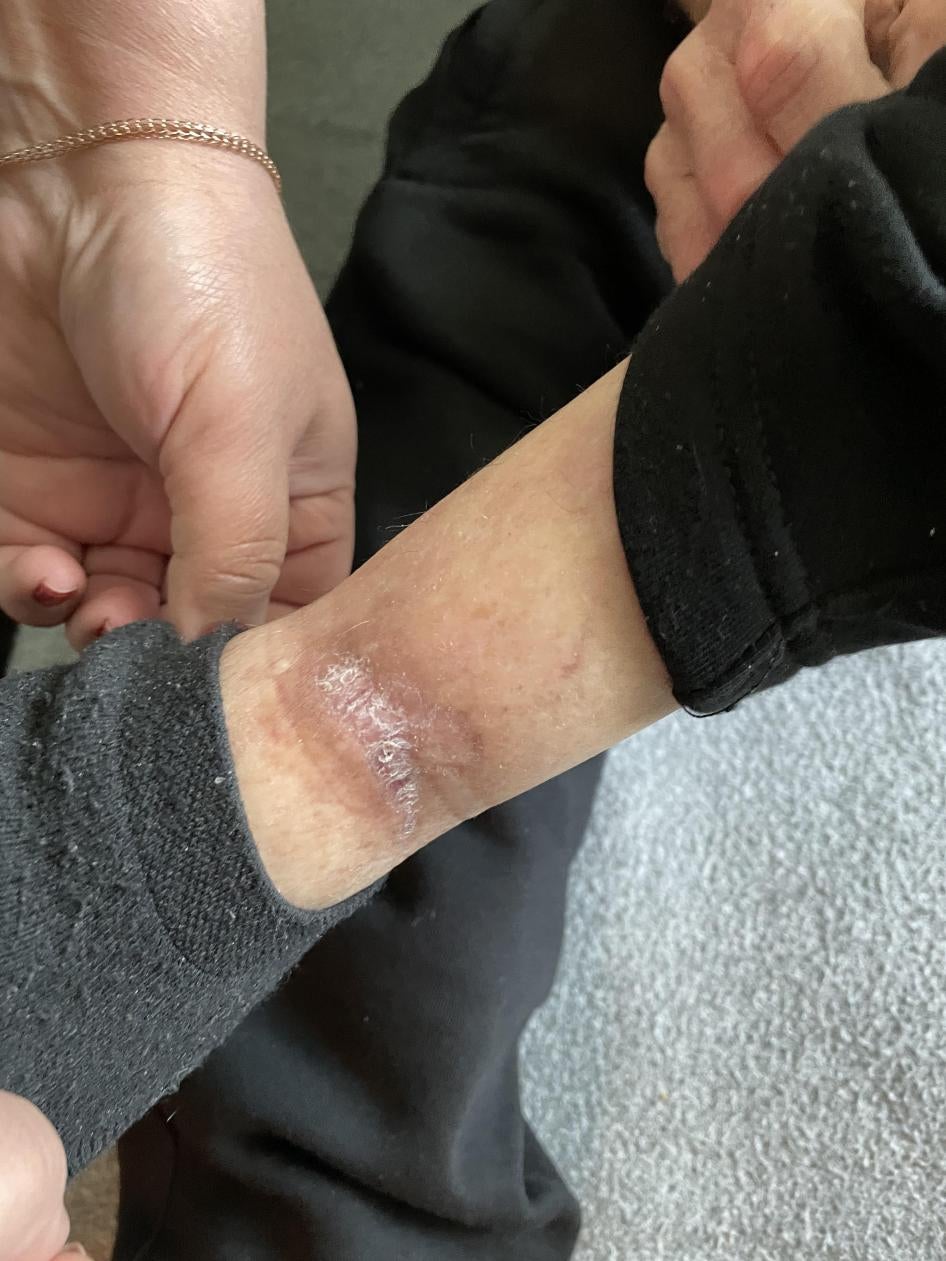 Scarring on Sasha Garakhanyan's ankle.
