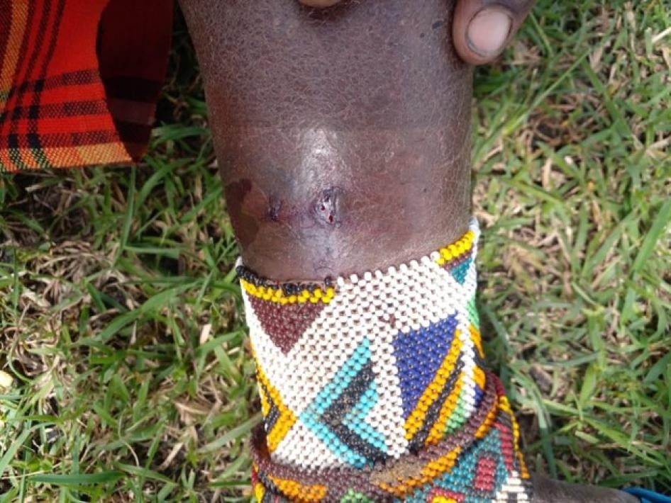 A Tanzanian Maasai woman shows her wounds after fleeing to Narok, Kenya for treatment. She said Tanzanian security forces shot and injured her leg with a rubber bullet in Loliondo, Arusha region, Tanzania, on June 10, 2022. 