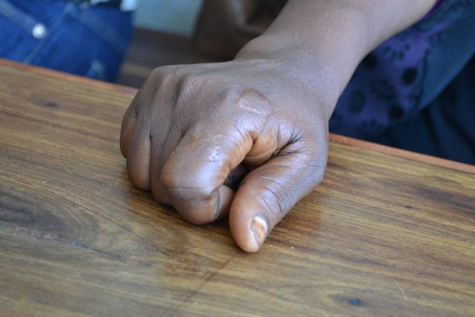 Rehema M., 30, said her employer in Oman forced her to work after she sustained a burn on her hand when a thermos she was cleaning exploded. Dar es Salaam, Tanzania. 