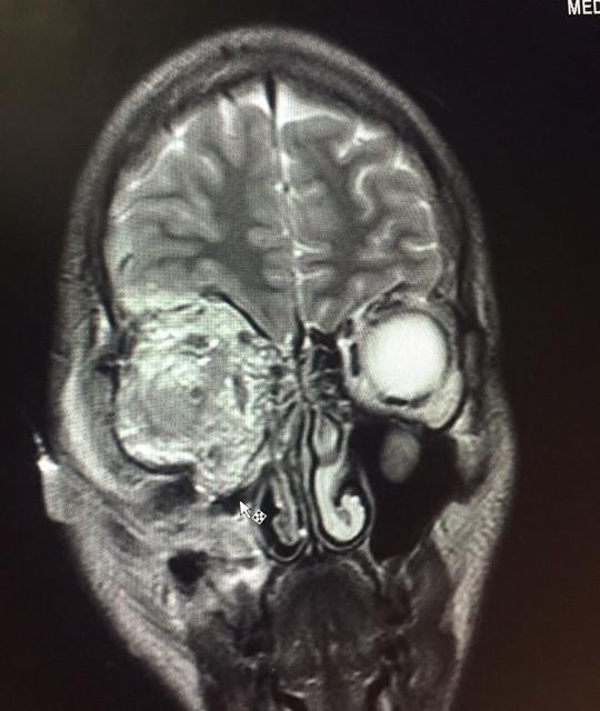X-ray of patient injured during an anti-government demonstration in Caracas shows impact on patient’s eye of being directly hit by a teargas canister, June 2017. © 2017 Private