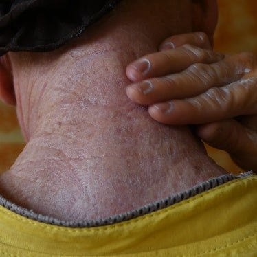 A man with albinism covers himself in sunscreen prepared by members of an NGO on August 18, 2016, in Abidjan, Côte d’Ivoire. 